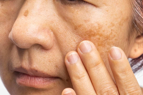 Remedies for Menopause Skin Discoloration