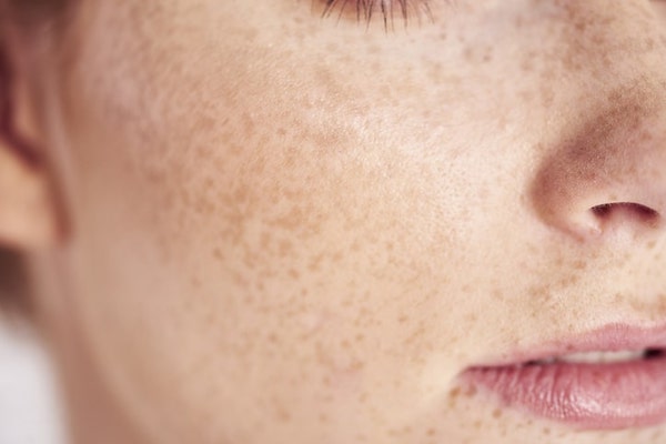 free radicals and skin