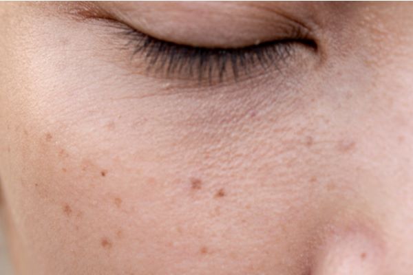 hyperpigmentation on face