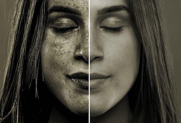 photodamaged skin
