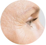 wrinkles around the eye