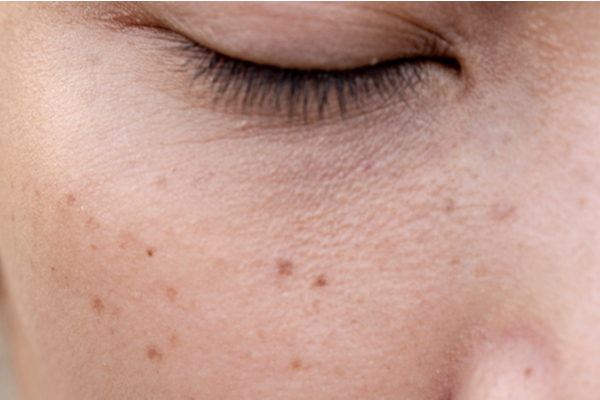 The Truth About Hyperpigmentation - Columbia Skin Clinic