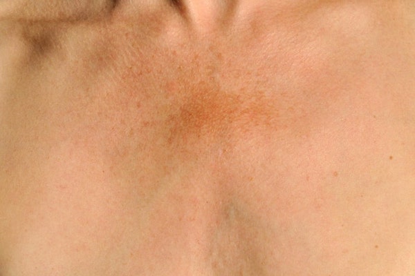 hyperpigmentation on chest