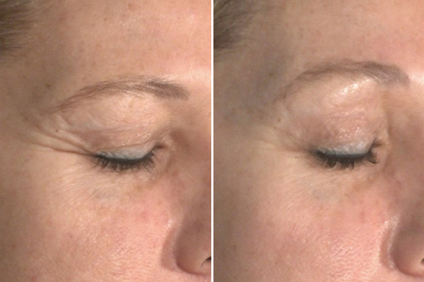 Tensage Growth Factor and crows feet before and after