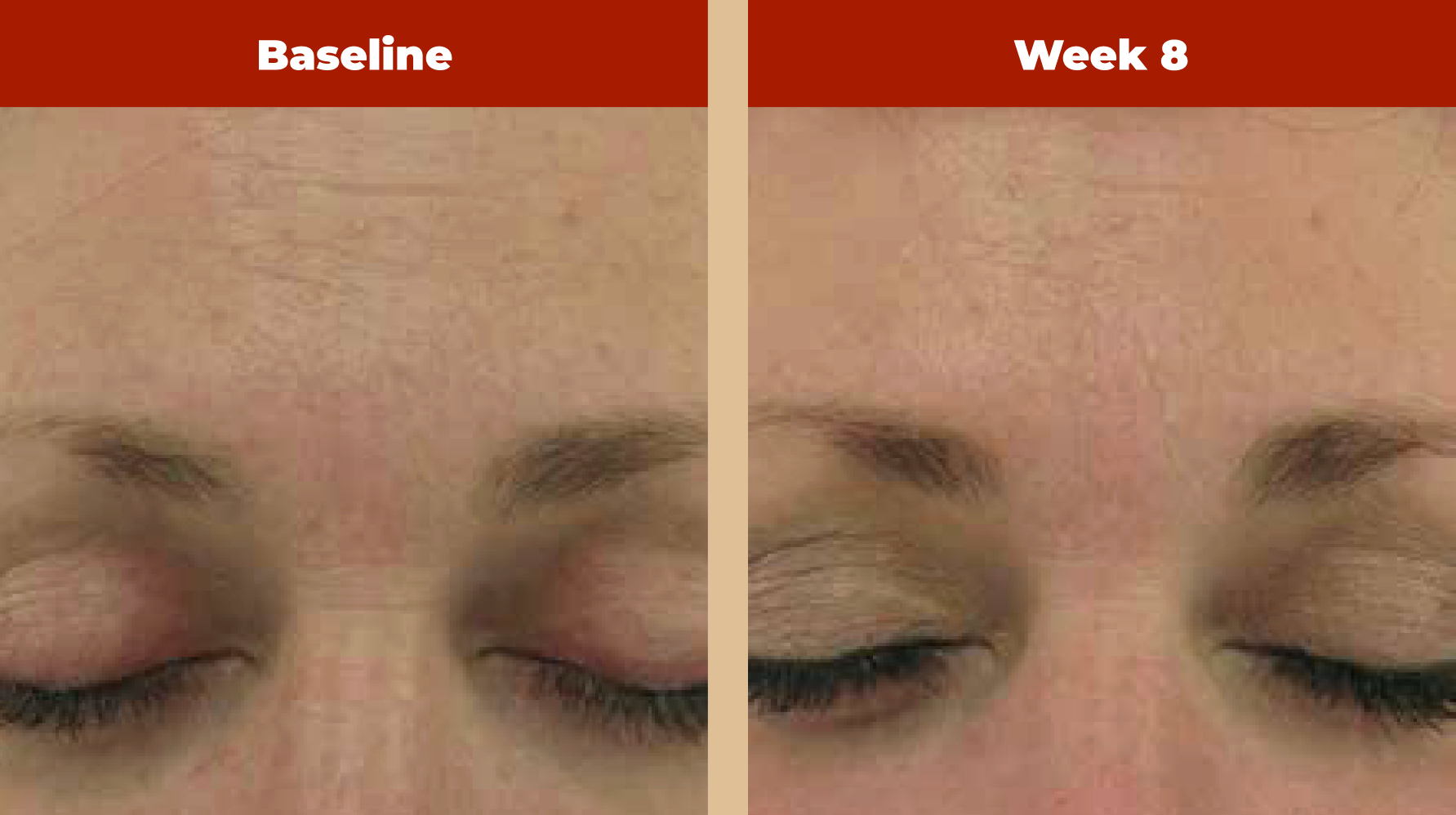 Unretouched photographs of patient at baseline and after daily evening use of Retriderm Mild 0.5%. Photographs courtesy of Michael Gold, MD.