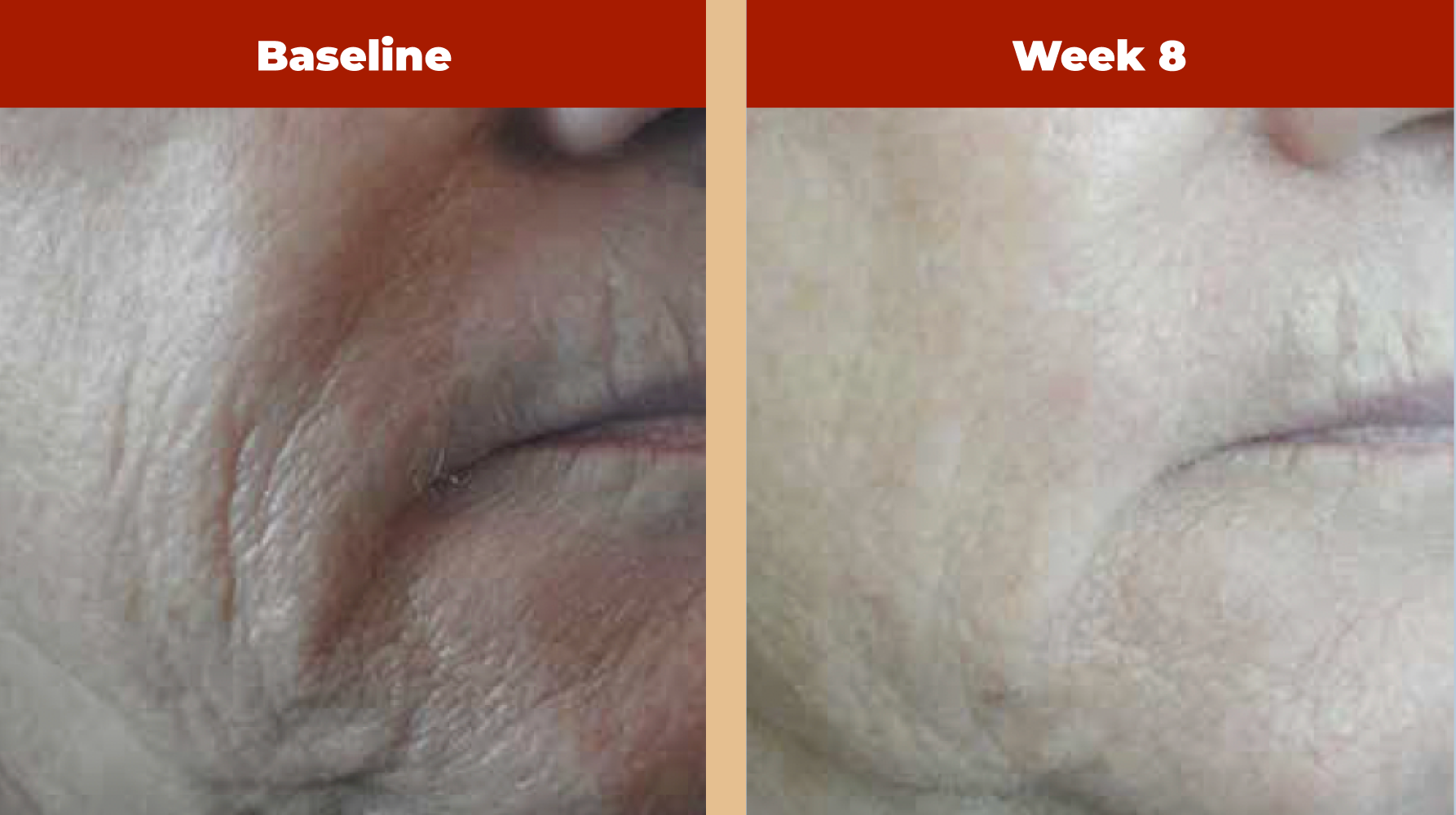 Unretouched photographs of patient at baseline and after daily evening use of Retriderm Max 1%. Photographs courtesy of Vivian Bucay, MD.